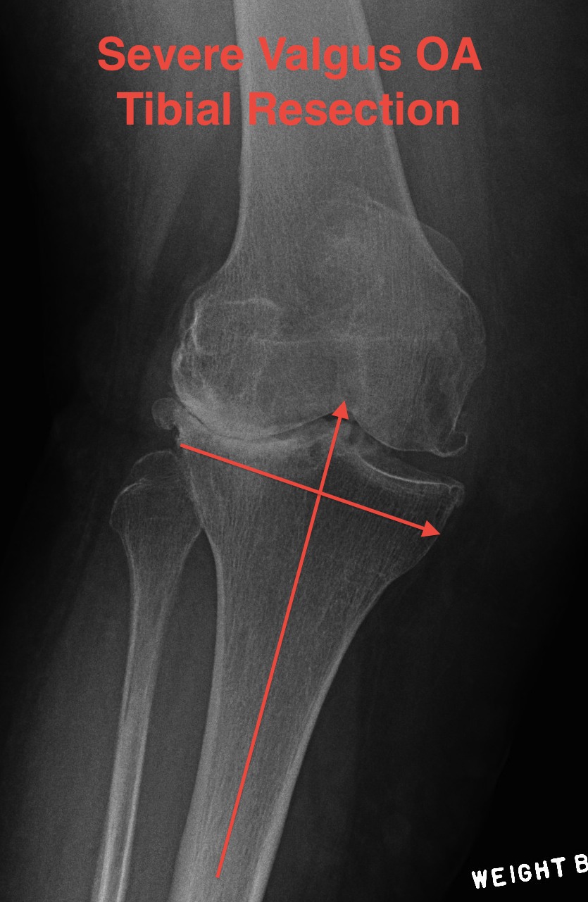 TKR Severe Valgus Tibial Resection Planning